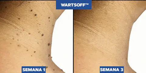 WART-QUITA VERRUGAS